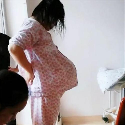 孕妈肚皮高挺似多胎,执意顺产,医生:"悬浮肚"只能剖,别想了