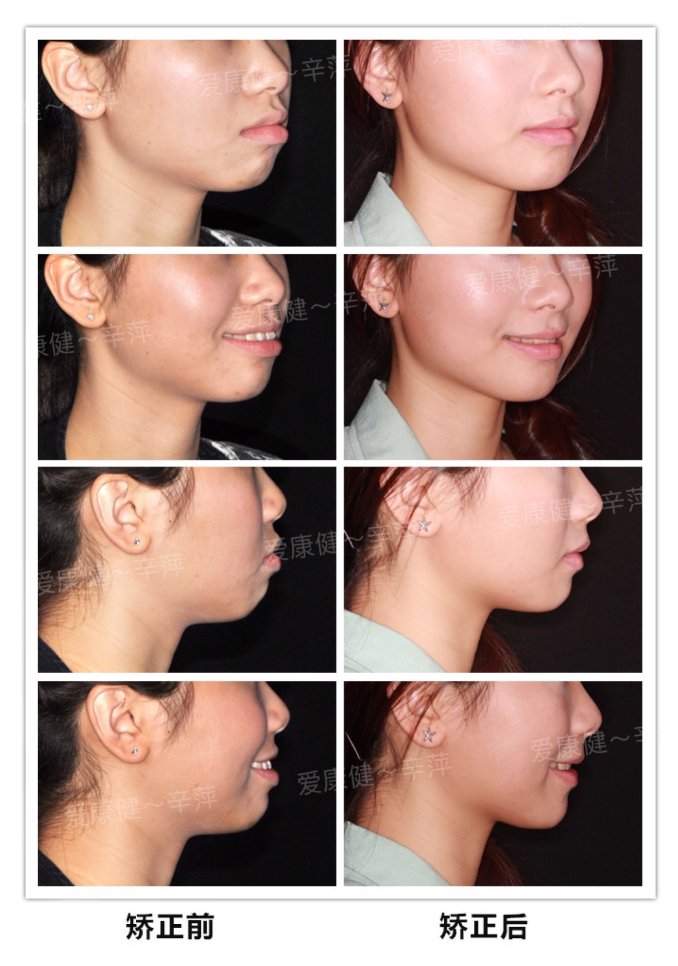 无论是骨性龅牙还是牙性龅牙,牙列的畸形还是需要进行正畸治疗的.