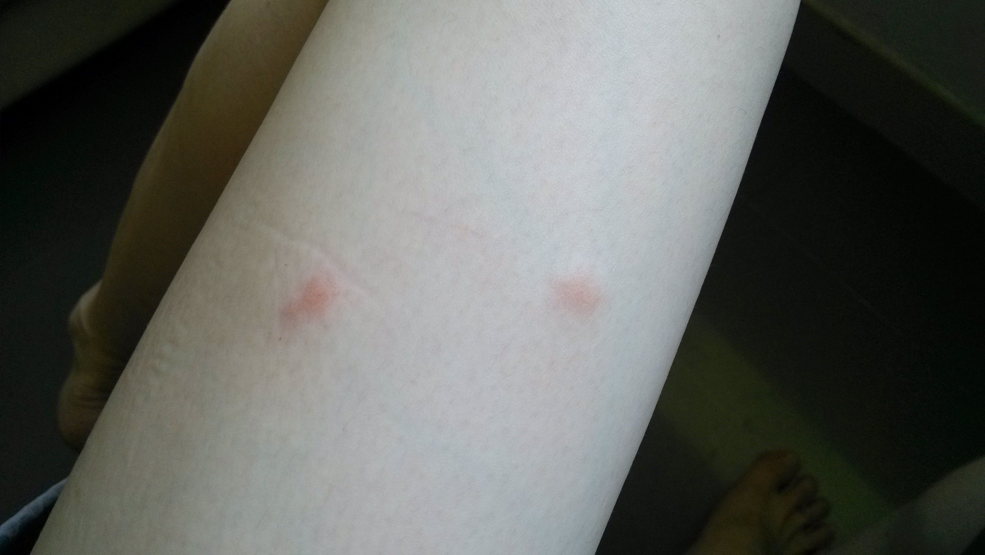 昨晚开了空调睡觉.早上醒来皮肤超痒.身上长了很多这个红疙瘩.