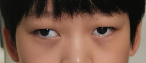 小儿斜视愁死人 市妇幼保健院眼科助您改"斜"归正