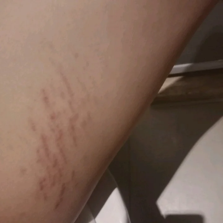 想问一下大家这个是什么纹,橘皮组织?肥胖纹?