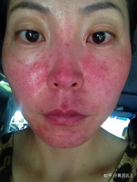 面部红血丝的成因及防治手段