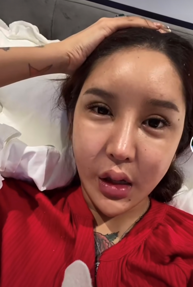 整容又失败,花费百万额头却现巨坑,曾面部神经遭压迫险失明_腾讯新闻