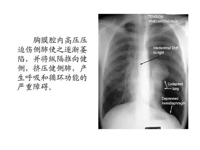 张力性气胸ppt