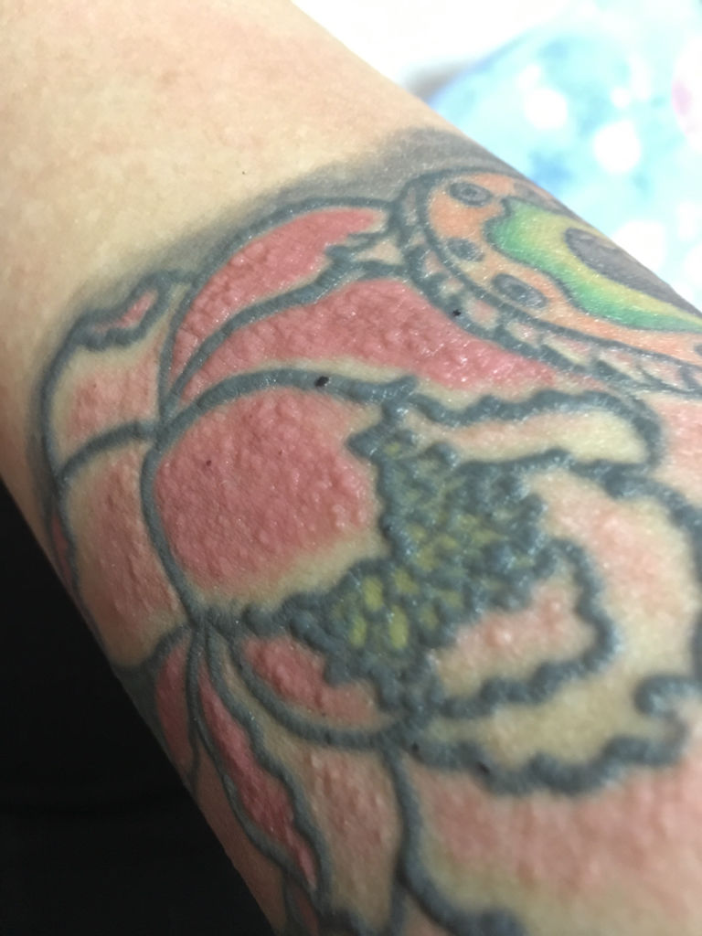 求专家解忧,这是怎么回事阿,纹身不分不算小,但是就是局部出现这种