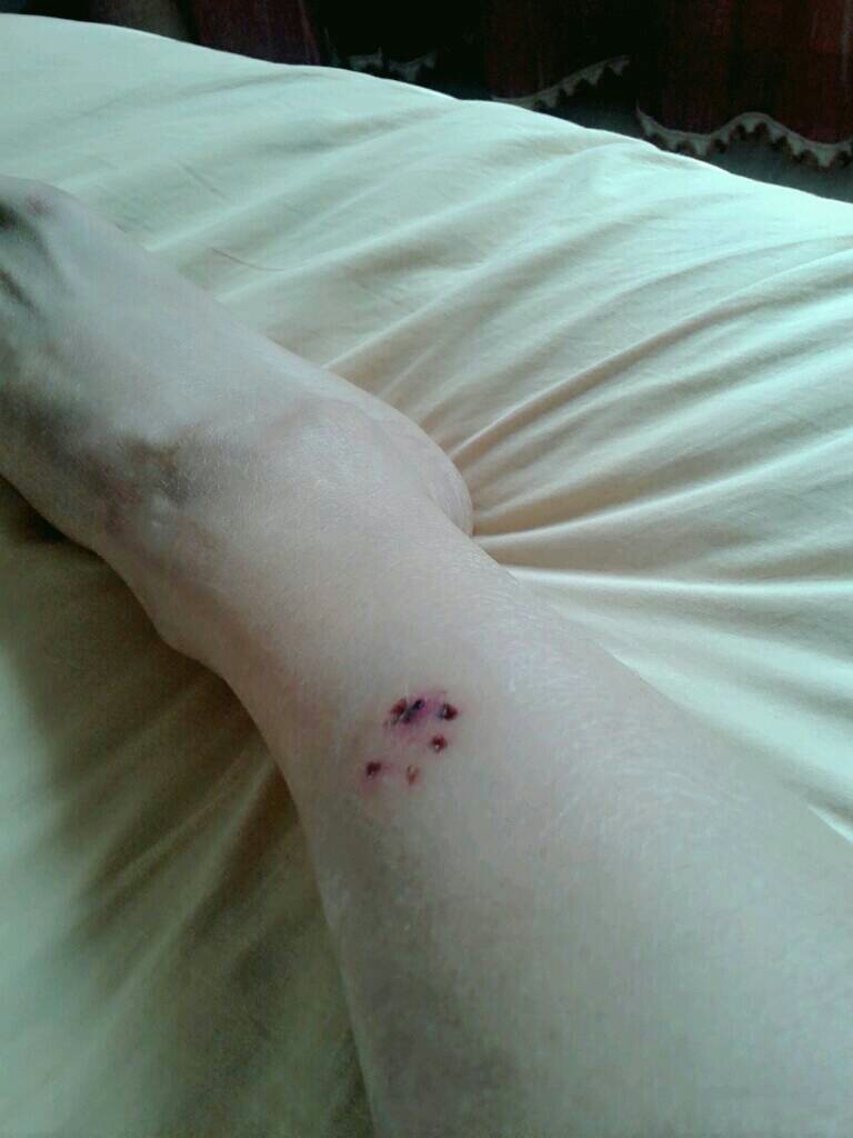 昨天晚上被家里的宠物犬咬了一下但是没有流血只有牙印几个,可我们在