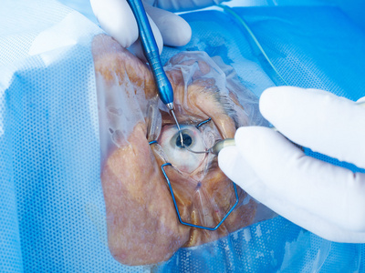 眼睛手术特写照片