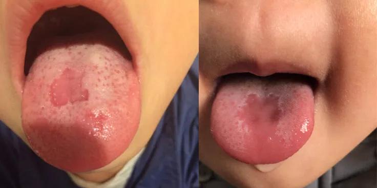 孩子舌苔脱落究竟是怎么回事?