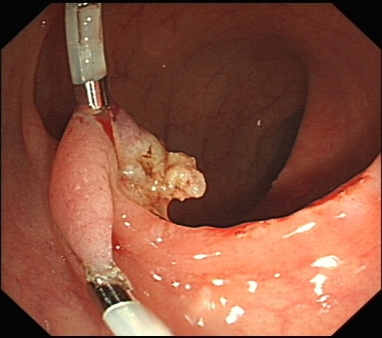 于蒂部夹持钛夹肠道见一巨大息肉,有宽蒂.