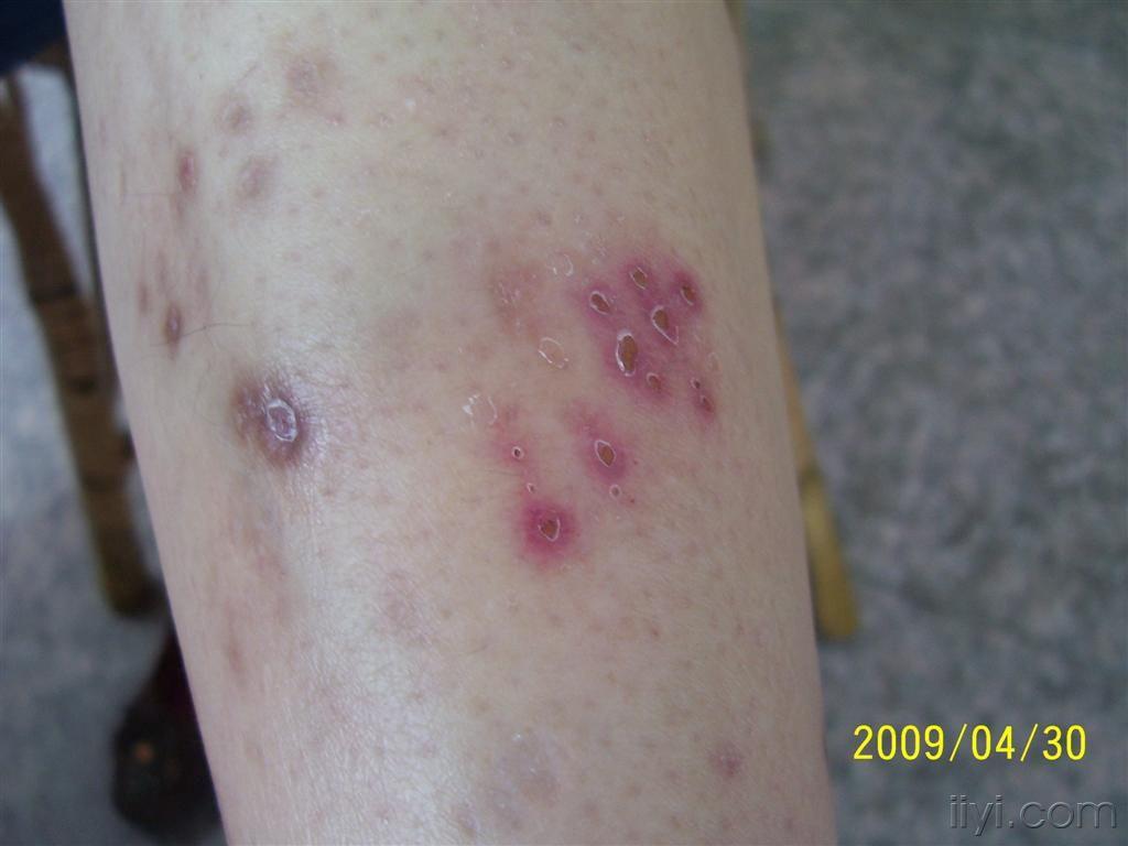 斑丘疹  糖尿病