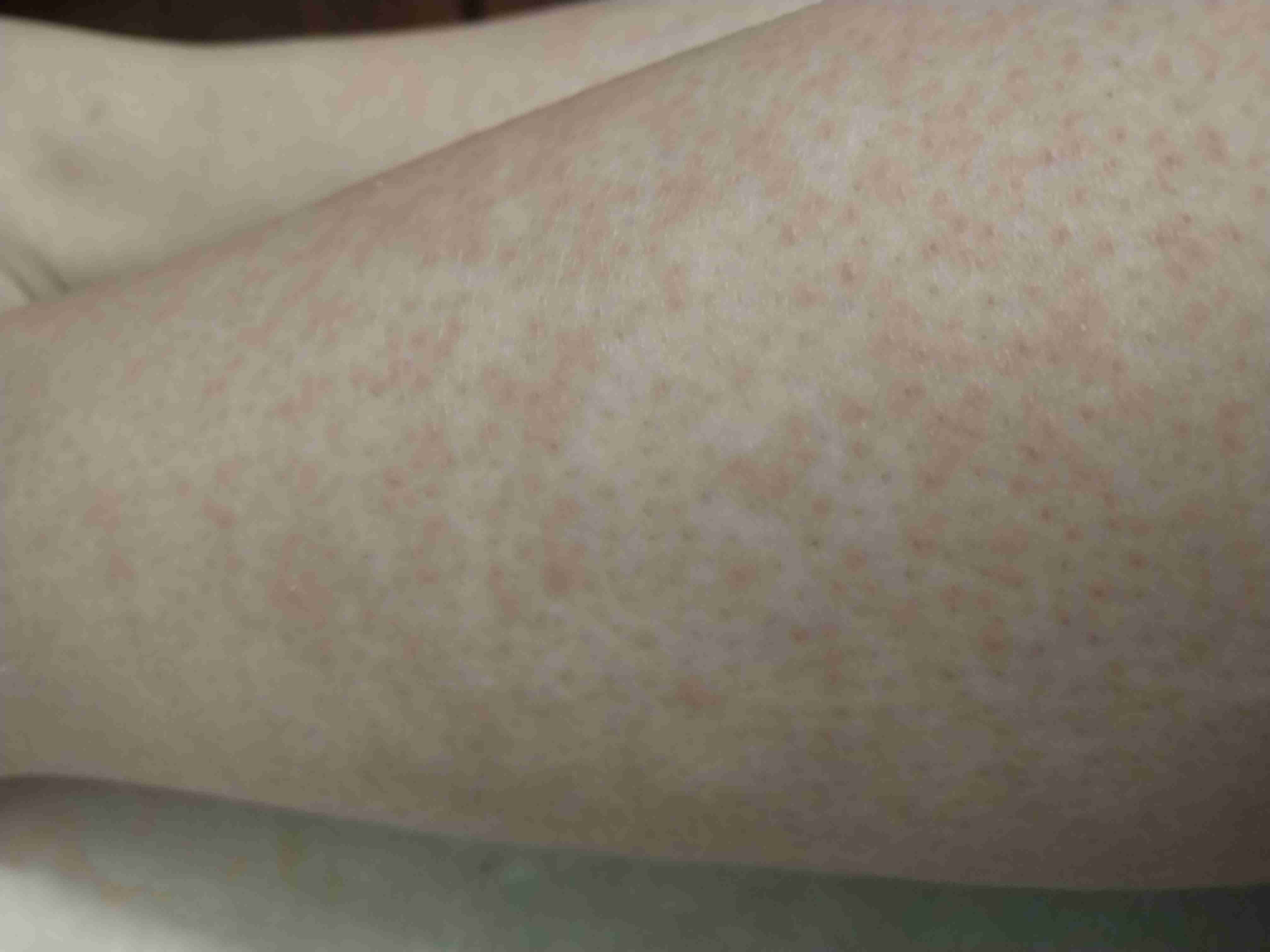 皮肤过敏出红疹,而且超级痒,要擦什么药?