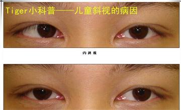 隐斜视的诊断