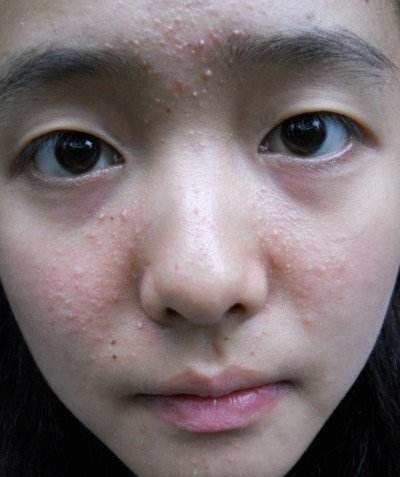 闭口粉刺图 (76)