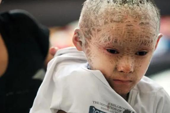 火棉胶婴儿长大后图片