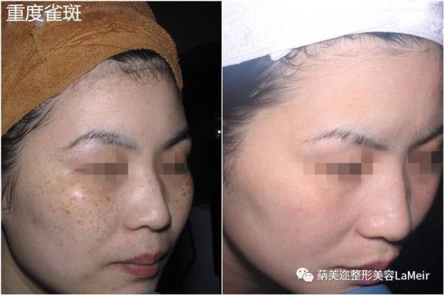 激光祛斑后"反黑"了?快来看你是哪种情况