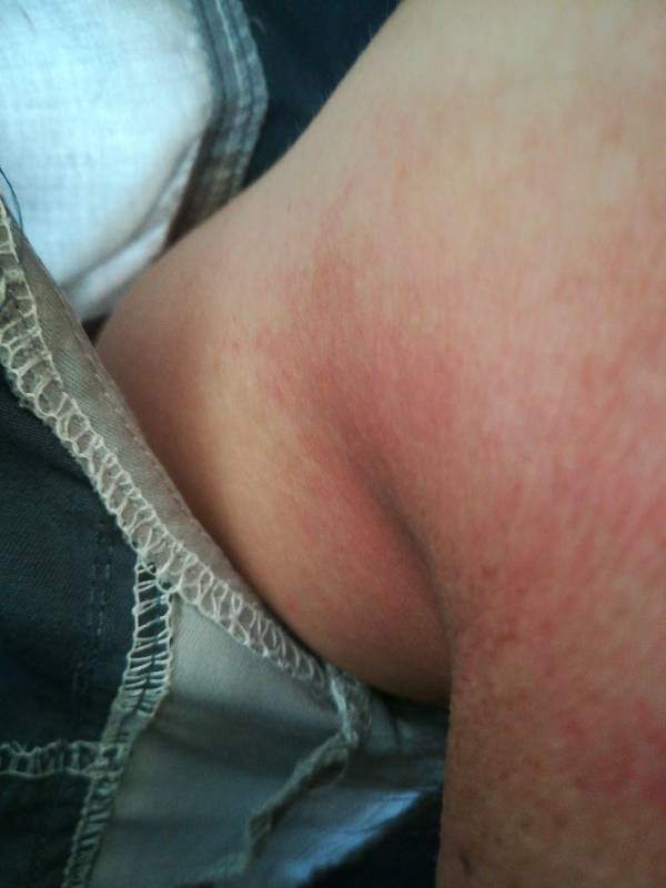 腋窝红痒 是湿疹吗?