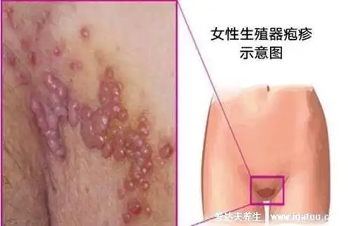 女性艾滋病妇科有什么症状,艾滋病妇科病