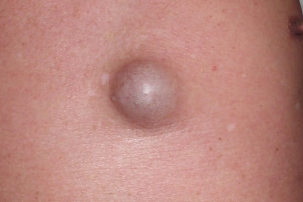 男性皮脂腺囊肿