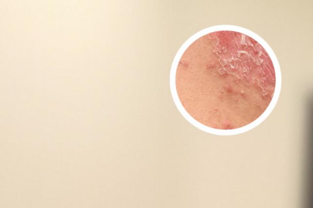 皮肤起干皮像癣一样图片-身上起了好多干皮像癣一样-手机名医汇