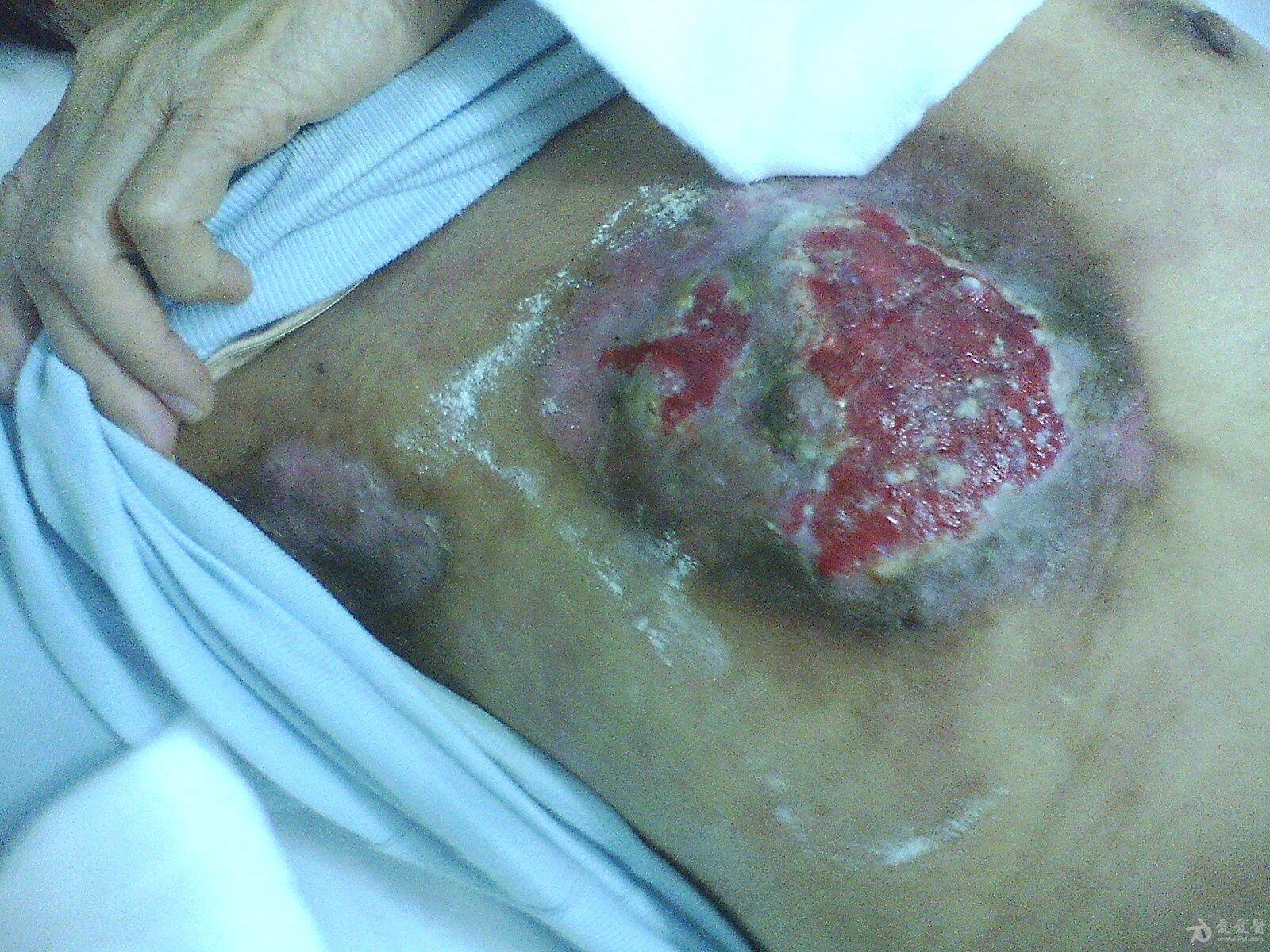 乳腺癌出现这情况请教下各位有没好的办法