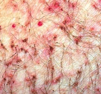 阴虱病症状与治疗