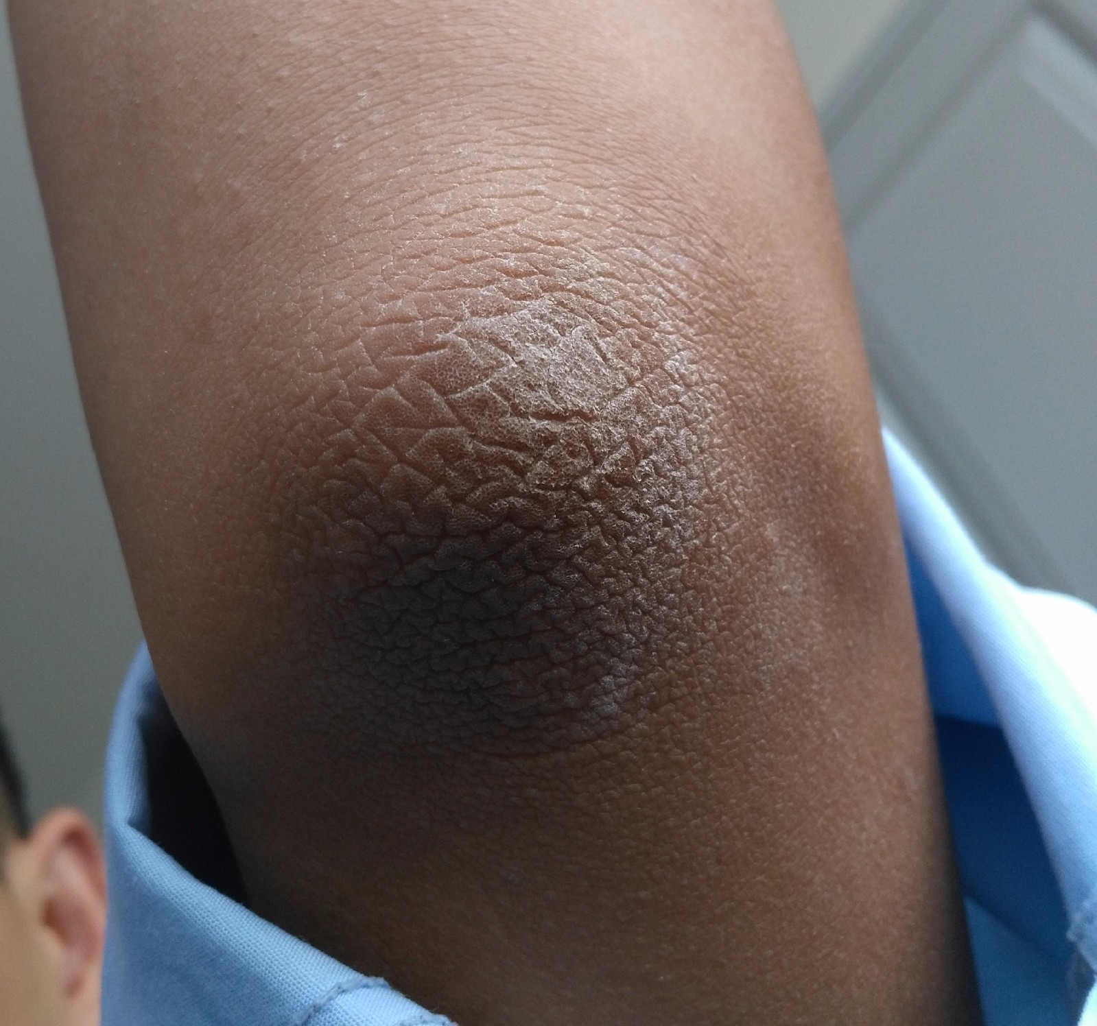 胳膊肘皮肤变成这样怎么回事?