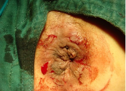 轻度外痔疮的症状的图片