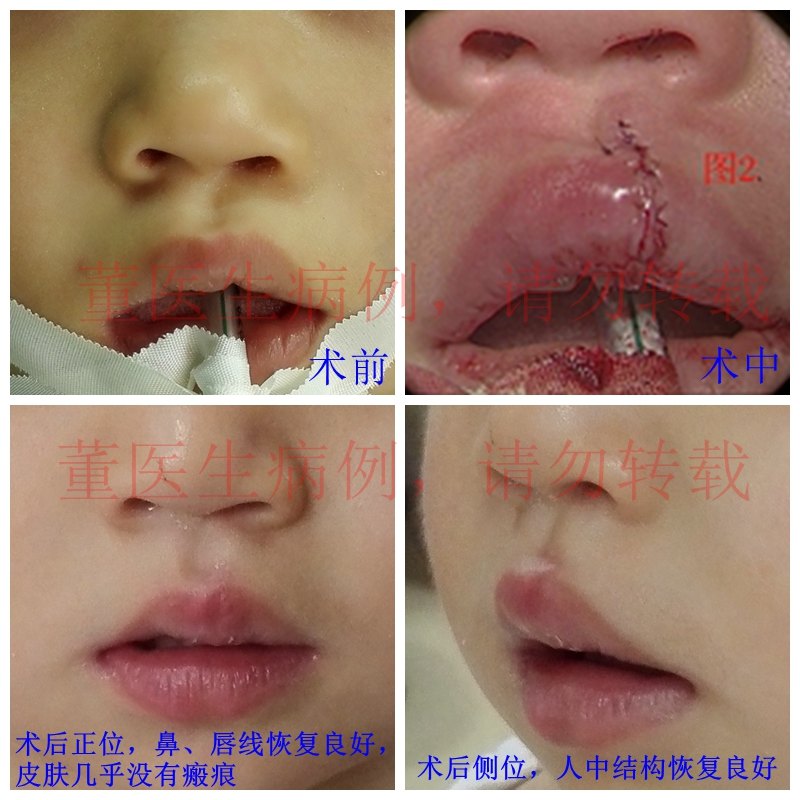 给隐性唇裂患儿家长答疑解惑