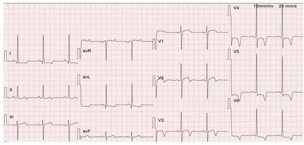 左心室肥大心电图你能看懂多少
