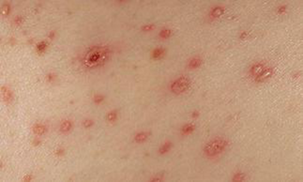 真实淋病症状皮肤自查图片 _有来医生