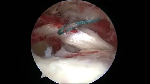 冈上肌腱u型撕裂镜下修补,lhbt重建cable术