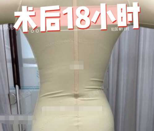 肚子吸脂15天恢复图,我做腰腹环吸亲身经历术后即刻_圈子-新氧美容