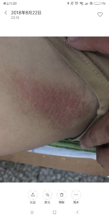 我想问大腿内侧一块红的有小疙瘩一碰就痛,走路都不行