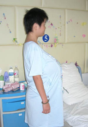 12岁女孩乳房如足球 做缩小术大出血险丧命(图)