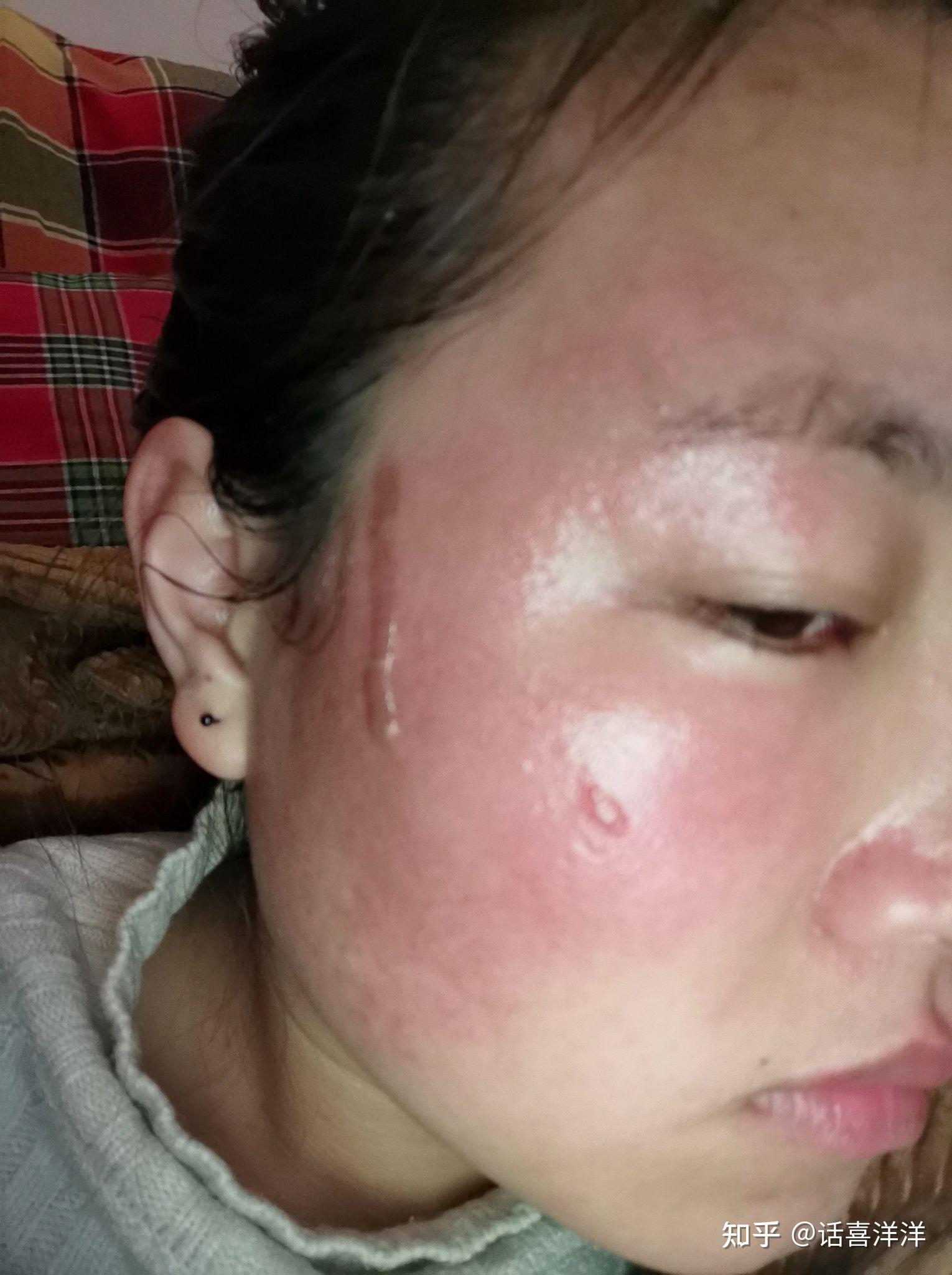 热油烫伤面部记录 - 知乎