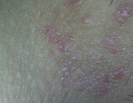 15岁女孩外阴有红色小痘痘很痒,是为啥?急