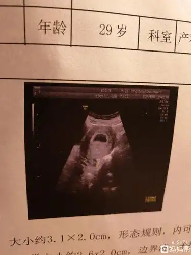 幸运!龙凤胎早期的孕囊图片"品质服务"-第2张图片-容克网