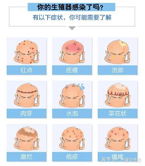 真菌,白色念珠菌,滴虫等致病细菌感染引起龟头炎,出现龟头褶皱红斑,若