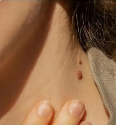 脖子上这种小肉疙瘩小心越抓越多