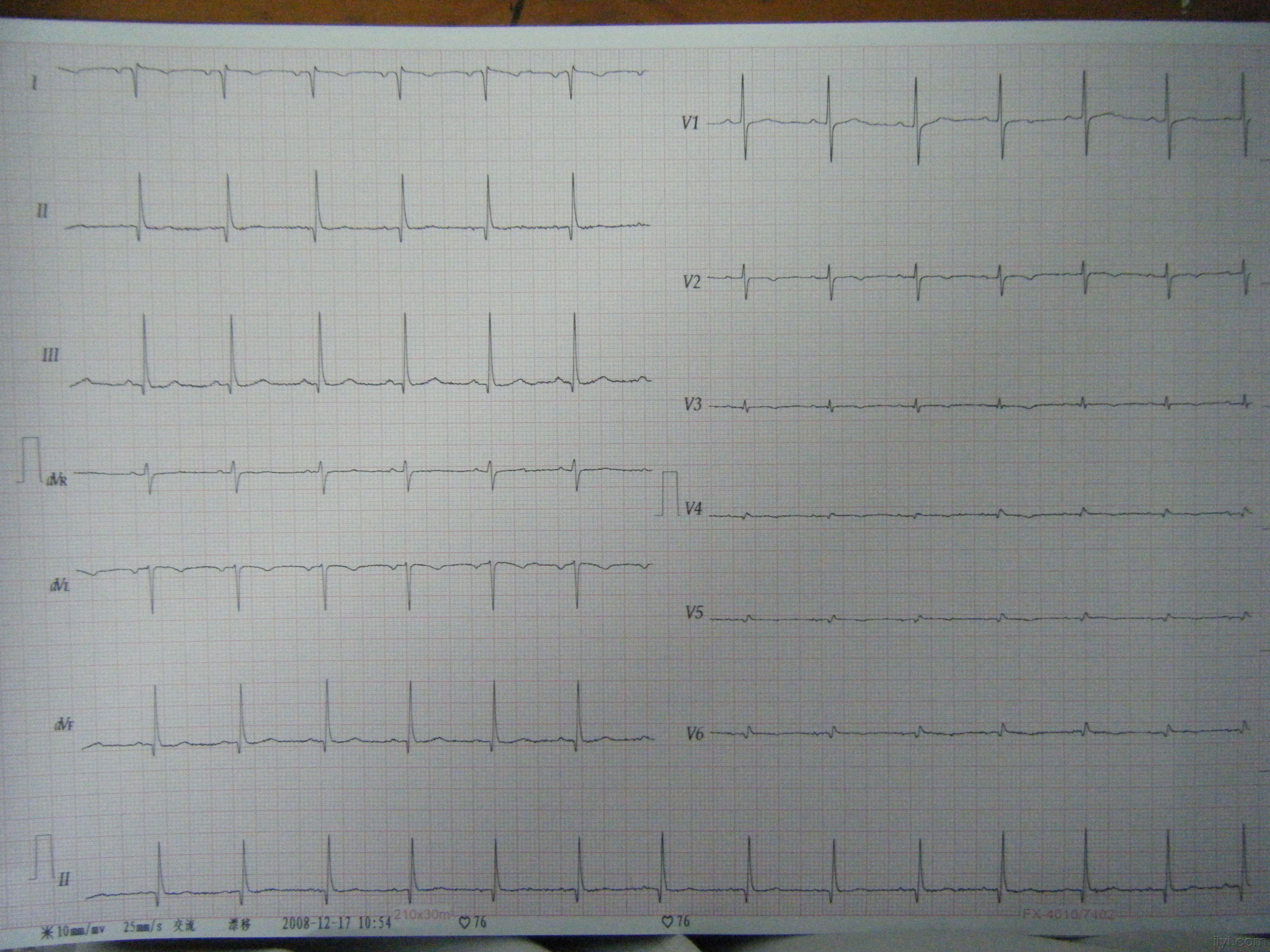 右位心者心电图 - 心电图脑电图专业讨论版 - 爱爱医医学论坛