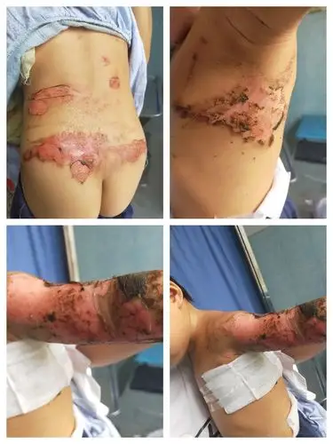 神农烧伤膏7天治愈1例严重浅2度烧病例,整个过程没有用到一点抗生素.