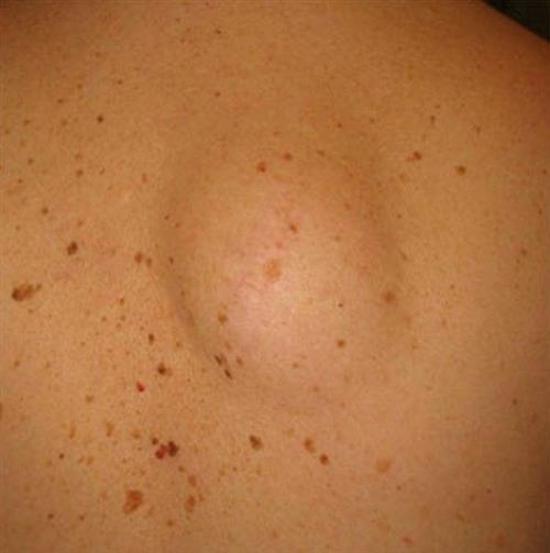 脂肪瘤怎么消除