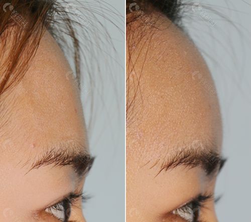 爱护医院额头填充对比照