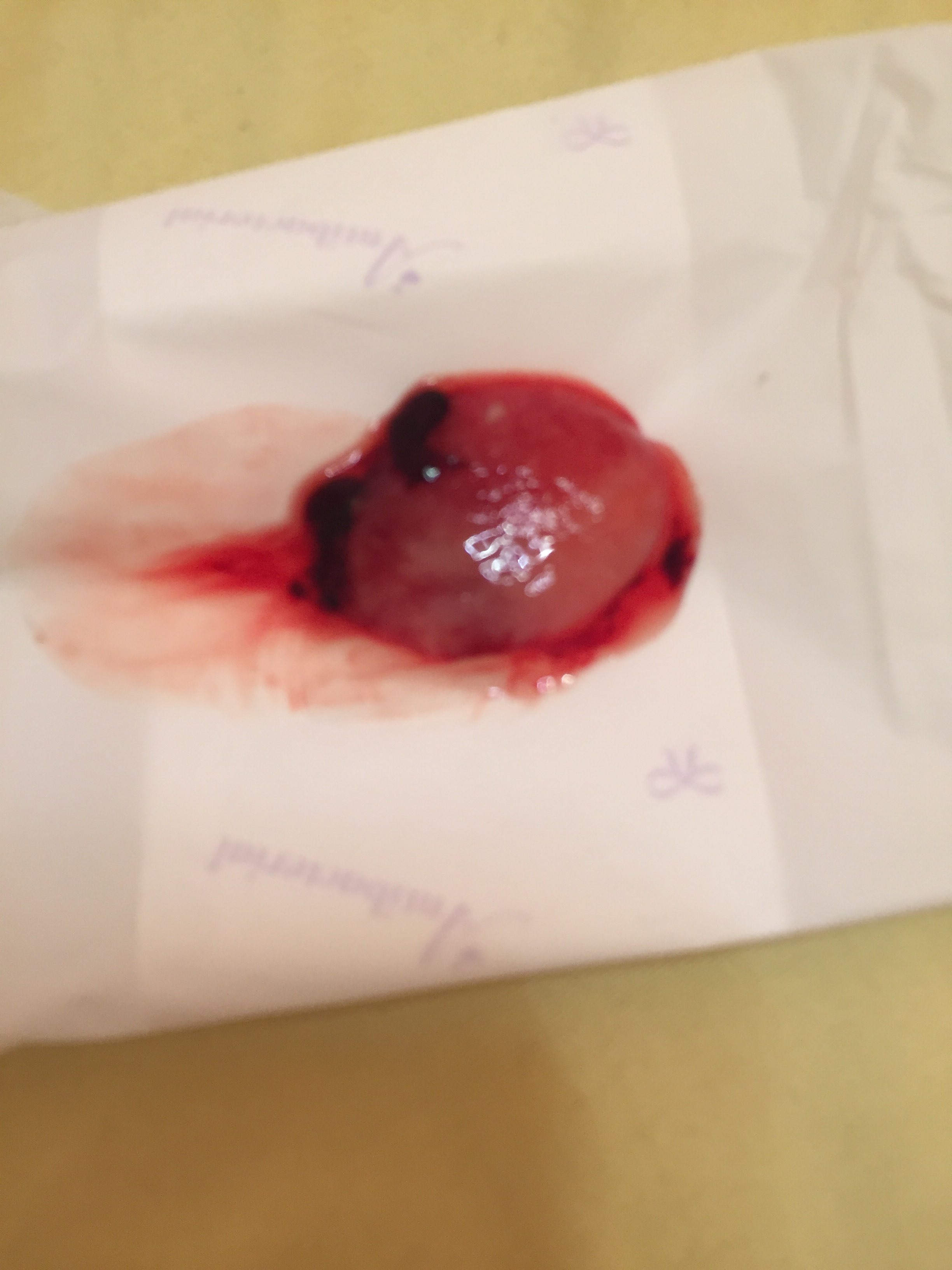 吃完米索一个半小时流出这个,是孕囊吗,因为复查需要等十几天,我想先