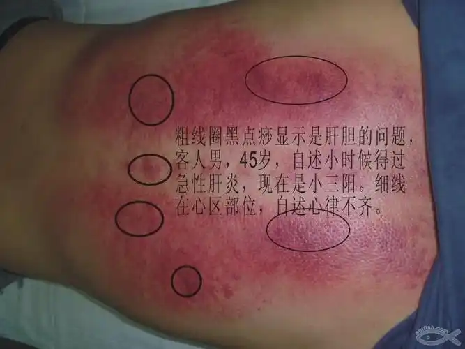 病理 刮痧的作用原理  病理刮痧基础知识笔记 刮痧汇总  刮痧颜色病理