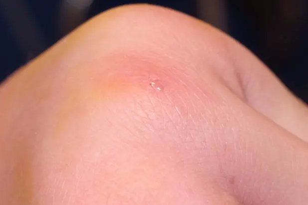 1,轻度轻度蜘蛛蜇咬的毒性反应表现为皮肤点状红斑,可有小皮疹或风团