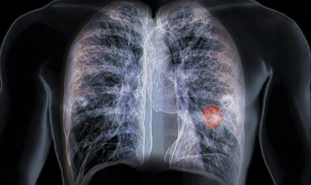 肺结核患者老年人占比逐年增高 且患者病"不知所起"-文交所资讯网