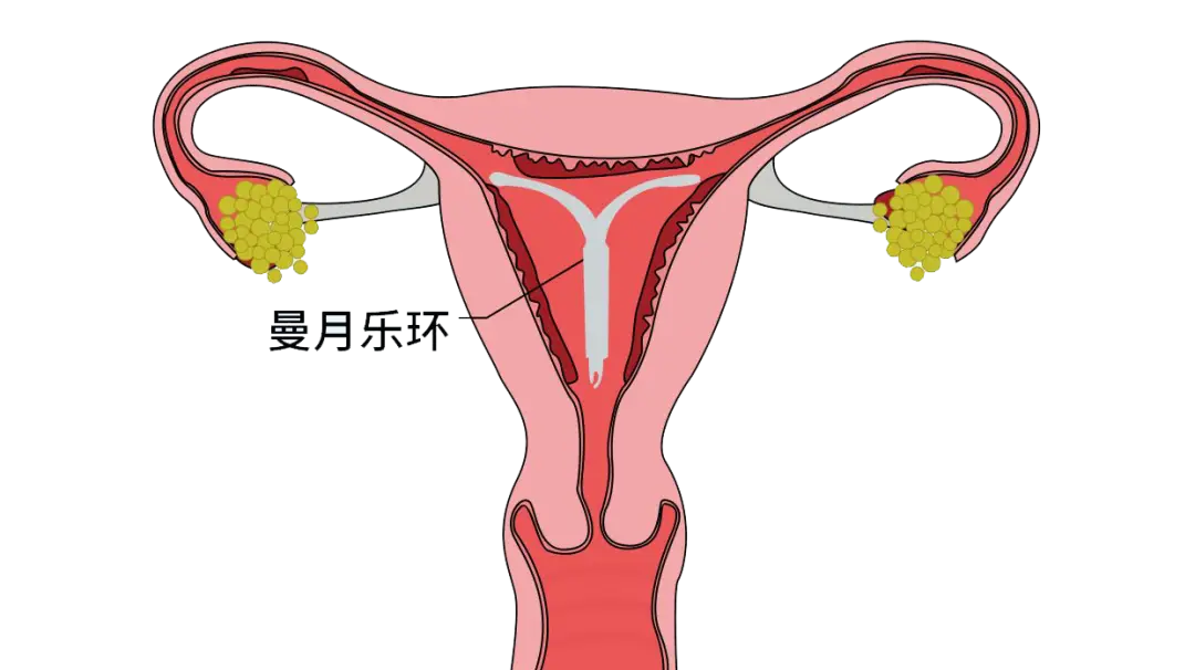 因部分患者子宫腔大,宫颈松弛或月经较多等原因,会导致曼月乐环下移