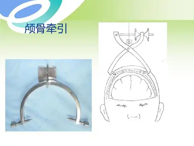 颅骨牵引