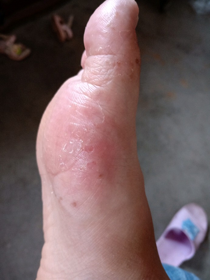 宝宝被我感染了水泡型脚气